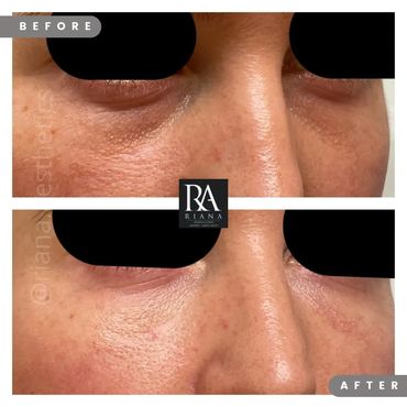 Tear Trough treatment for dark circles