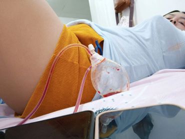 A person lying down with a catheter bag attached.