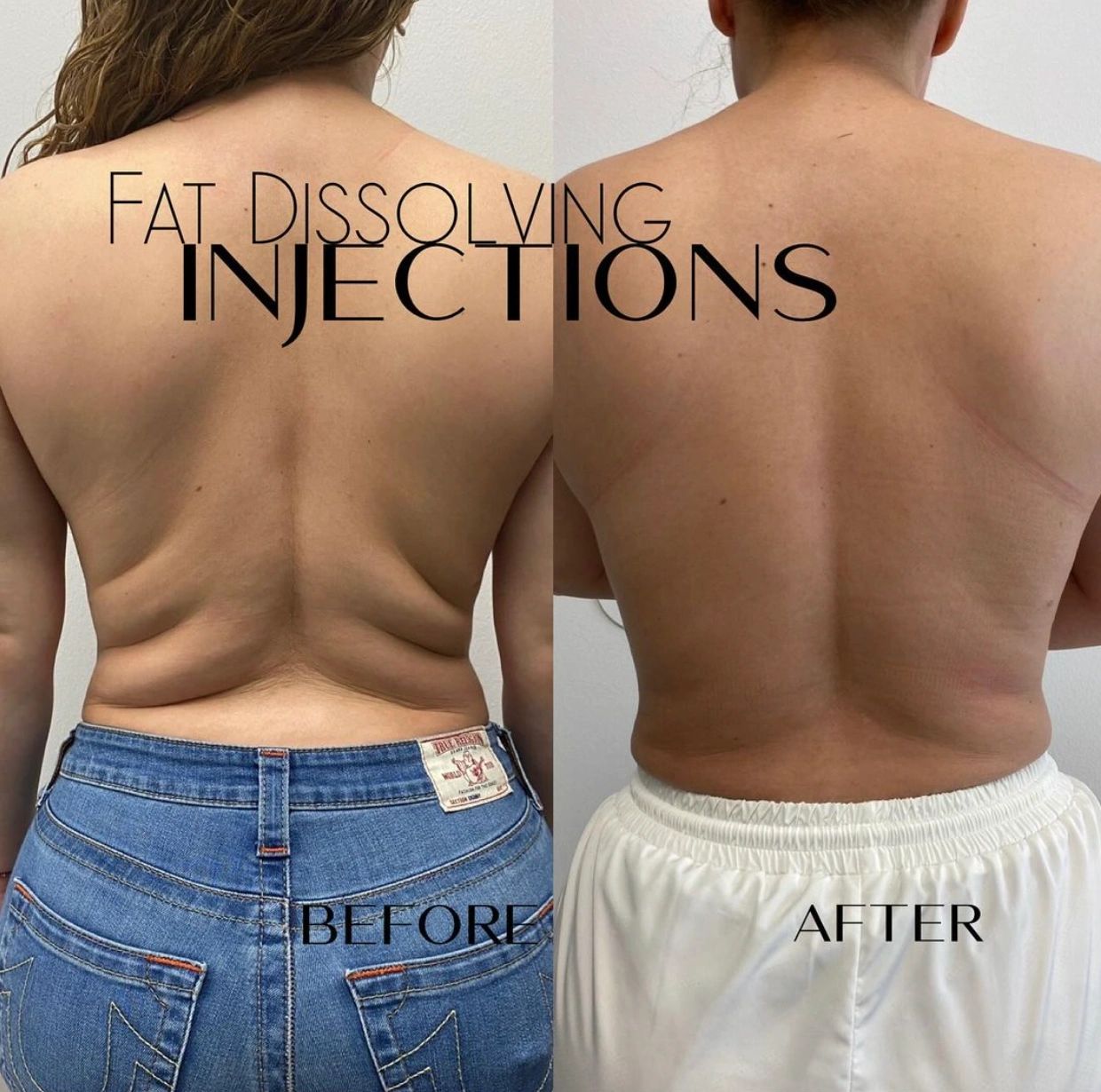 lipo c injections before and after Dissolve: The Best Fat-Melting Injection Treatment Weight:450ML skin renewal ipamorelin effects on sleep