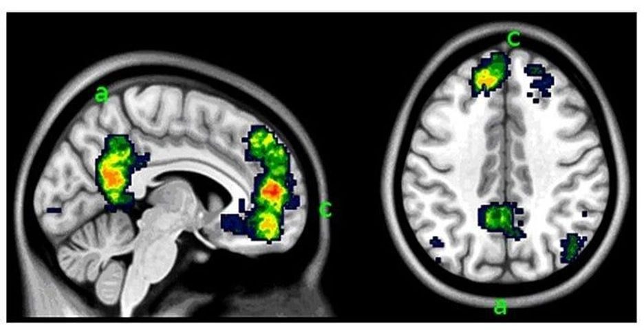 Figure 1: This brain scan of a depressed woman after psychotherapy indicates activity in the limbic system (a) and the prefrontal cortex (c ). [26.1]