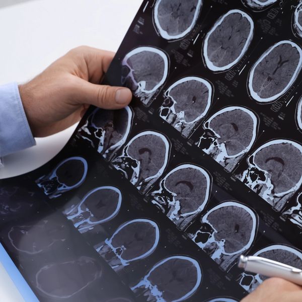 Doctor examining brain MRI scans for diagnosis.