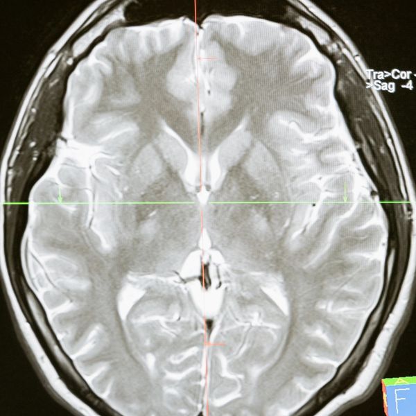 Axial MRI scan of a human brain showing detailed brain structures.