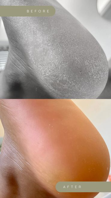 Transformational before and after photos of a clients feet at my nail salon in Milton Keynes