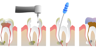 Painless single sitting Root Canal Treatment