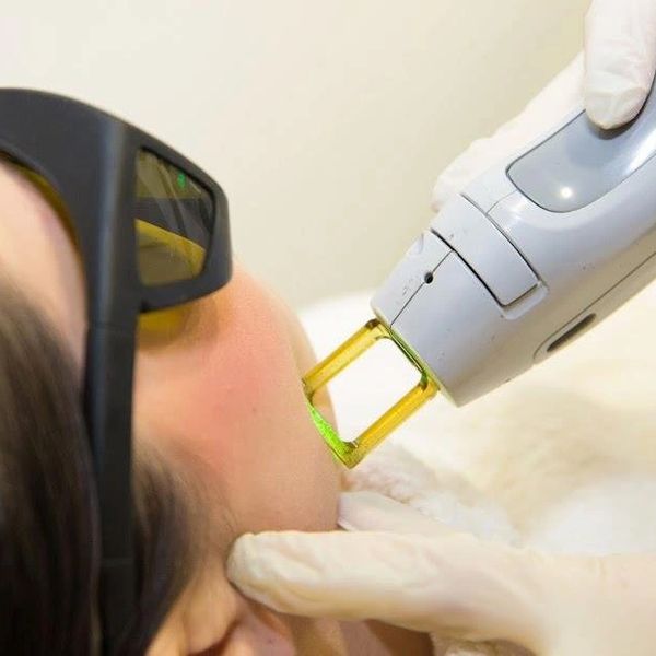 Vessel removal and the treatment of diffuse redness are being conducted using our Candela laser.