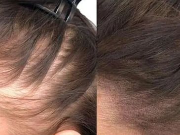 Hair density treatment for thinning hair and hair loss for women in Coulsdon