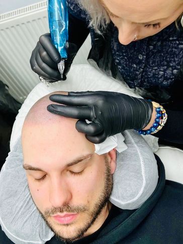 Scalp Micropigmentation fake hair tattoo in Coulsdon