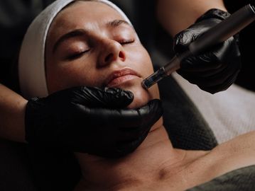 Microneedling with PRP treatment for skin rejuvenation and collagen stimulation in Havant.