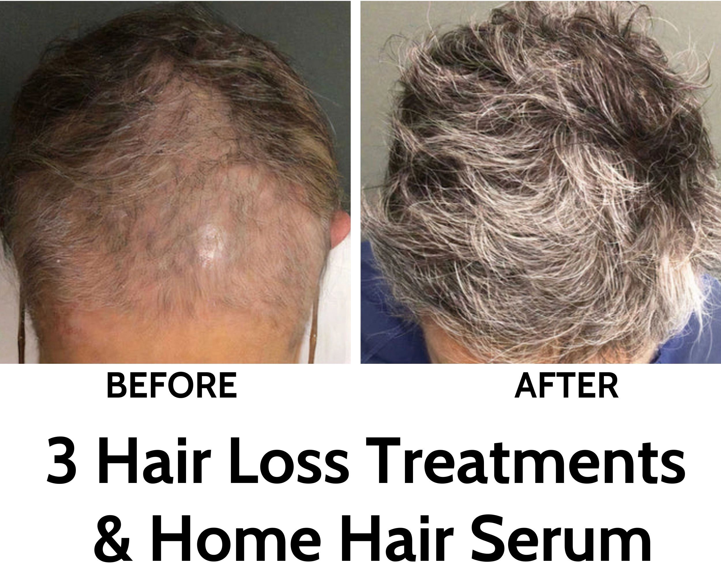 Hair restoration, hair loss treatment, male baldness, alopecia areata, alopecia, thinning hair