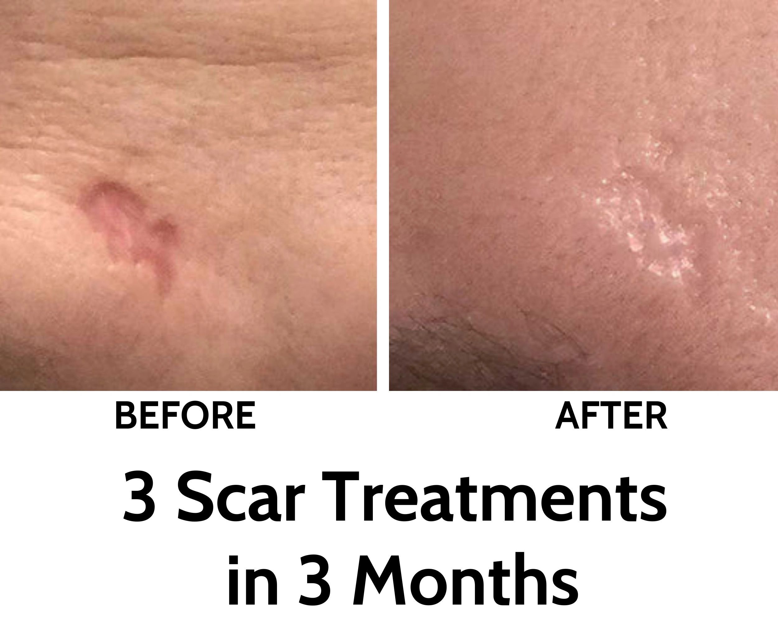 best scar mark treatment, pimples and scars treatment, zit scar, facial scar, scars on face, scar