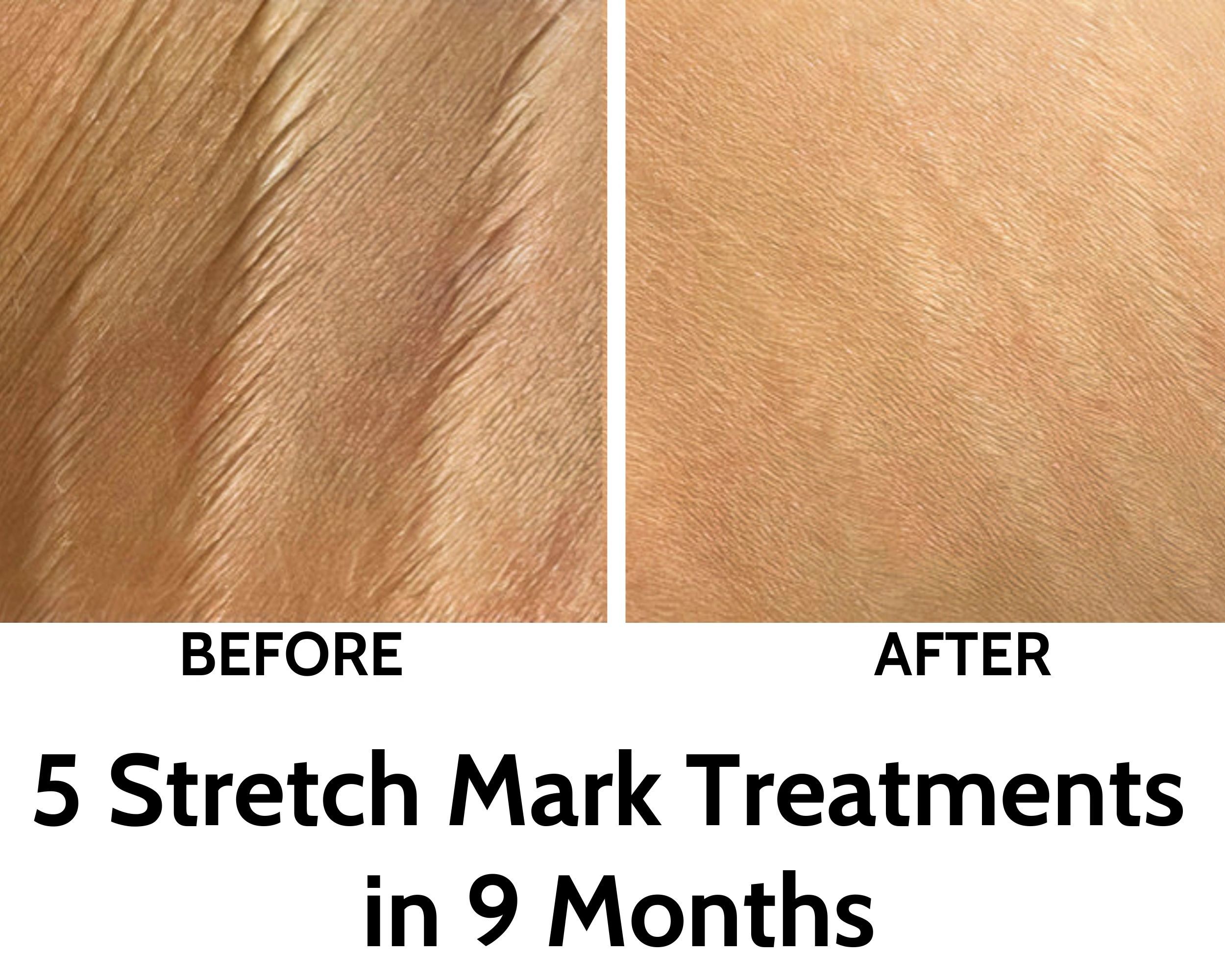 best stretch mark treatment, mark stretch, stretch mark removal, belly stretch marks, striae marks