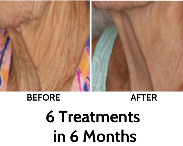 microneedling benefits, neck wrinkles, jowls, neck creases, best aging skin care, wrinkles neck