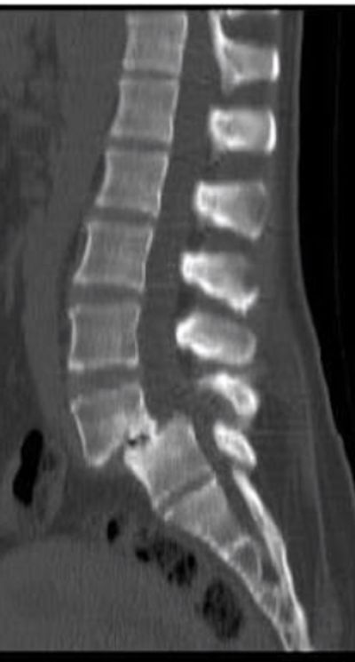 Tomografía de columna lumbar Caso radiológico ESPONDILOLISTESIS, Tomografía de columna lumbar Caso radiológico ESPONDILOLISTESIS ☢🐝 ☢🐝  ☢🐝 Video nuevo #radiologia #tomografiaabdomen #estudiantesdemedicina, By Abeja Radiológica