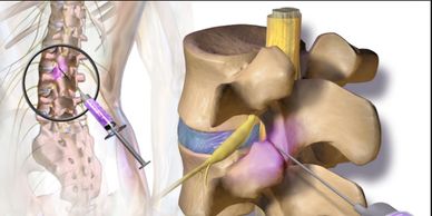 Bloqueio ou Infiltração na coluna. Tratamento SEM cirurgia para hernia de disco e dores nas juntas