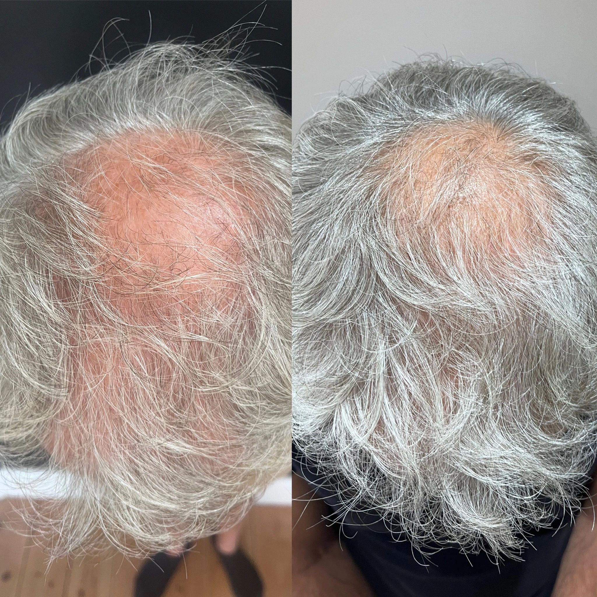 Before and after images of a person's scalp showing increased hair density.