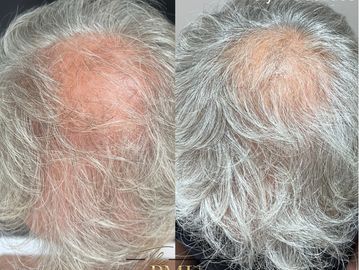 Photo of a client before and after polynucleotide treatment to the scalp, resulting in hair growth