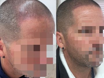 Client before and after photo of a hair density treatment (scalp micropigmentation)