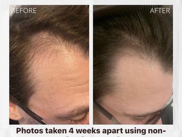 Client before and after microneedling for hair loss, resulting in hair growth