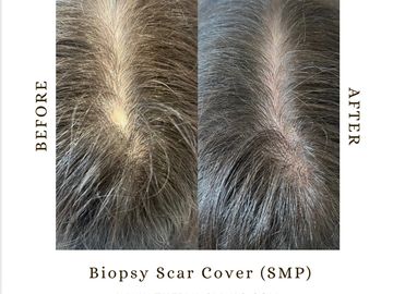 Client before and after photo of a biopsy scar cover using Scalp Micropigmentation