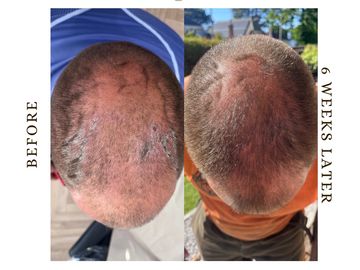 Client before and after photo, due to sea buckthorn oil, resulting in improved scalp health