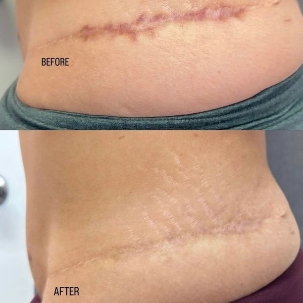Scar lightening after 3 sessions of lighten service.