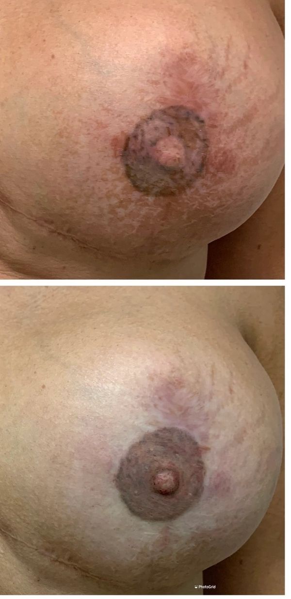 3D areola and nipple reconstructive tattoo after botched tattoo.