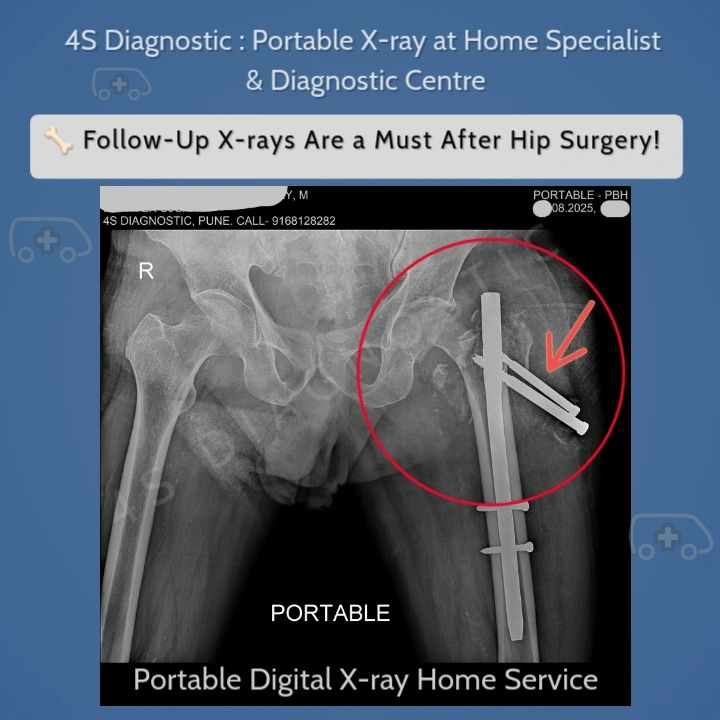 Stuck Up X Rays Why Follow-Up X-rays After Hip Surgery Are Crucial – A Real Case