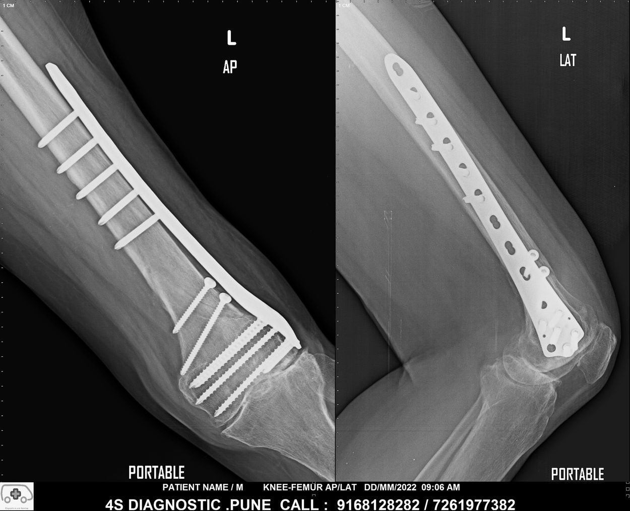 Femur with Knee x-ray done on portable digital x-ray machine - home service