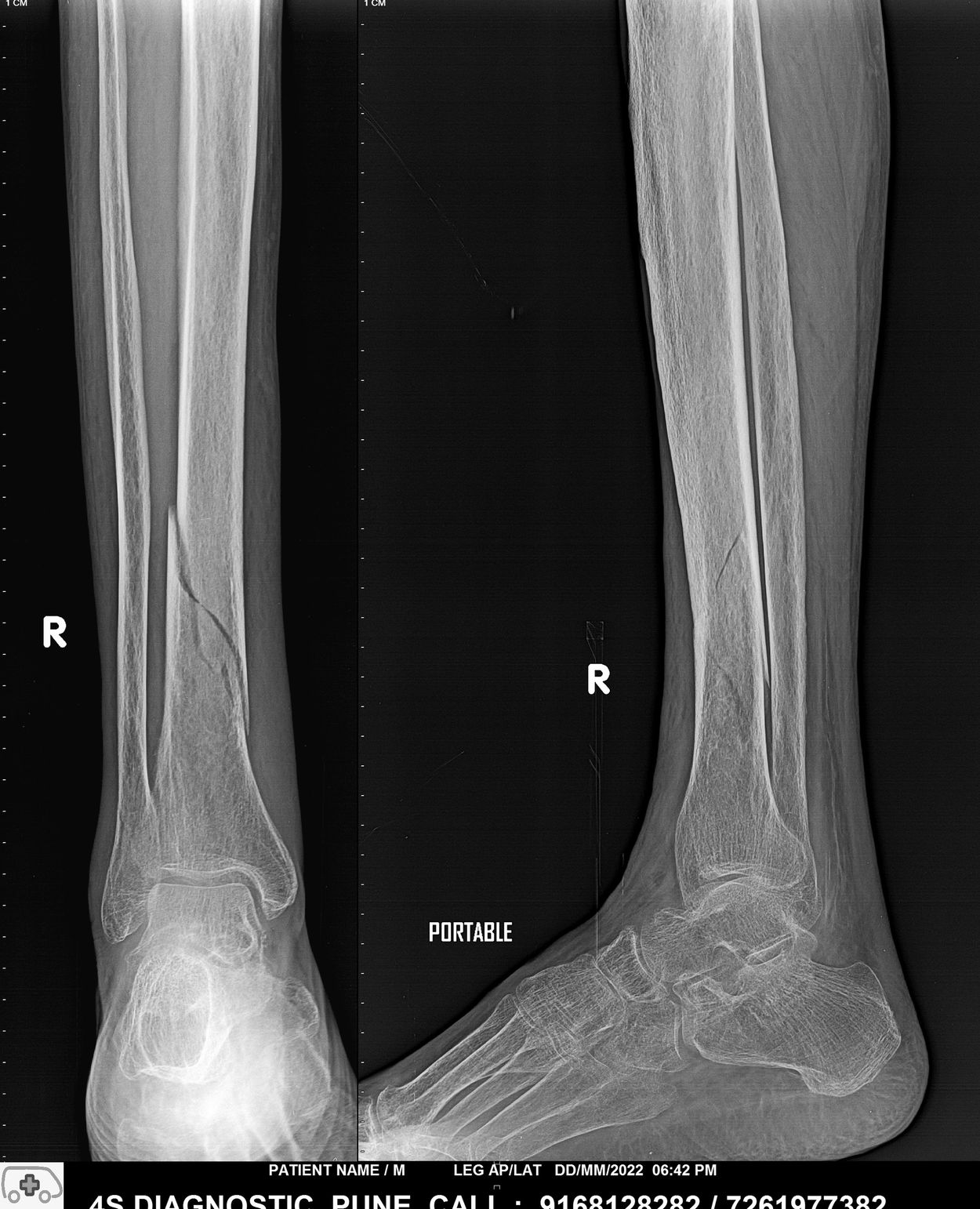 Leg x-ray done on portable digital x-ray machine - home service