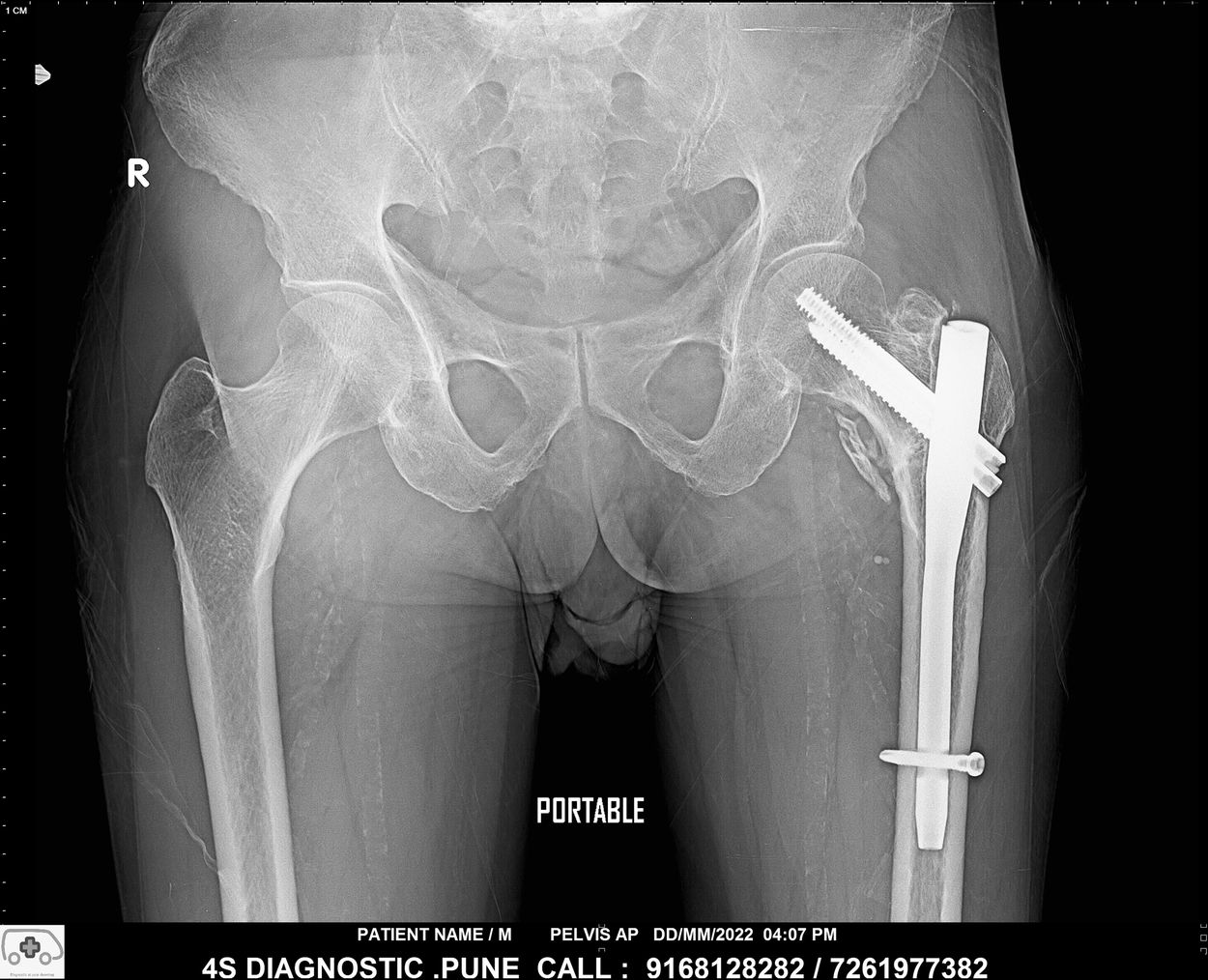 Pelvis with both hip joints x-ray done on portable digital x-ray machine - home service