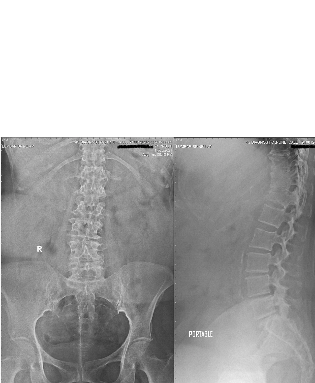 Spine x-ray done on portable digital x-ray machine - home service