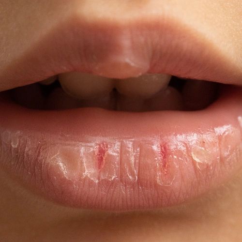 Zoomed in photo of dry, cracking lips