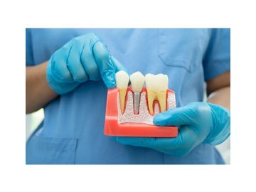 Single Implant  tooth 