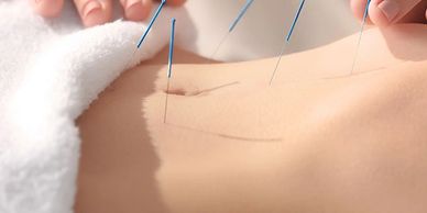 Abdominal needling for Women's Health.