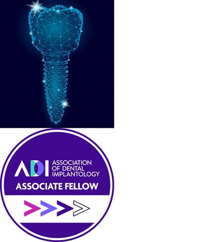 Dental Implant Livingston