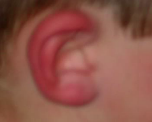 red ear syndrome