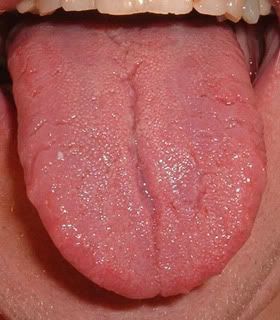 Unhealthy Tongue