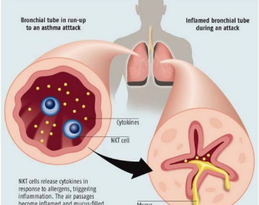 Natural Asthma Treatment