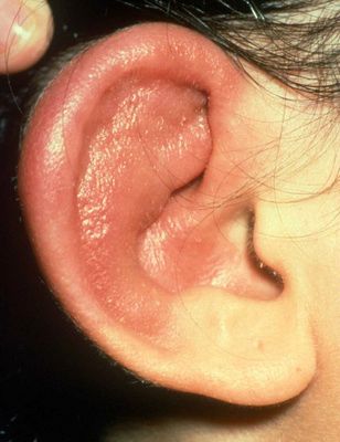 Relapsing Polychondritis