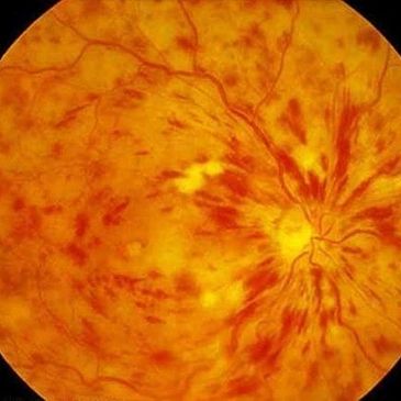 An image showing retinal tear / detachment.