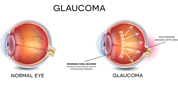 A diagram of a normal eye next to an eye that has glaucoma.