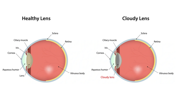 Diagram showing an eye with a healthy lens next to an eye with a cloudy lens.