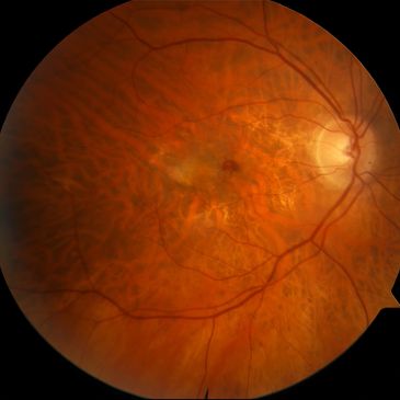 The inside of an eye with macular degeneration.