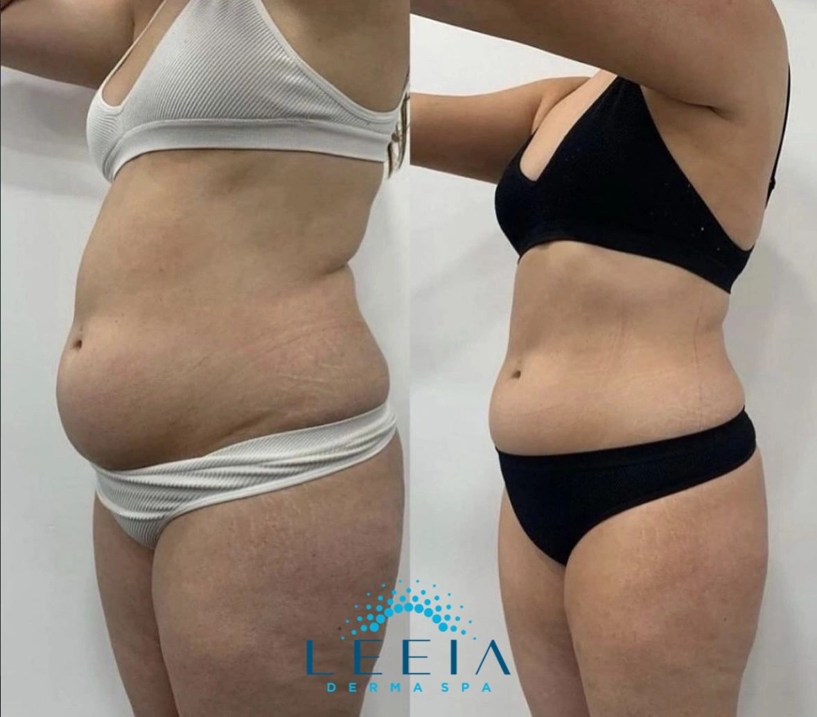 EMS Body Sculpting (Electrostimulation) in Montrose, Chicago