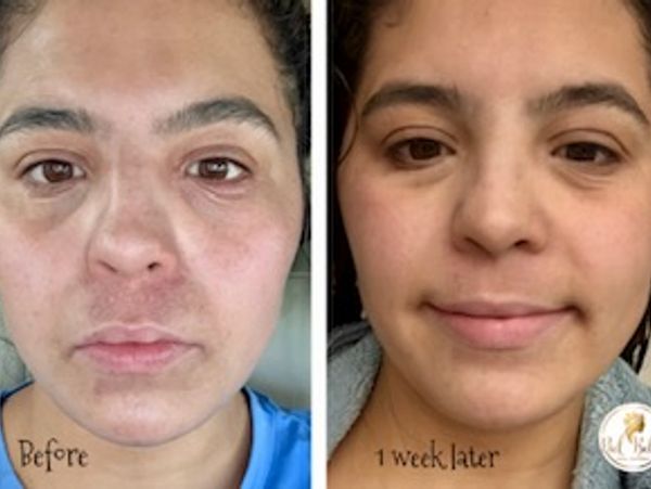 Before and after photos showing facial improvement after one week.