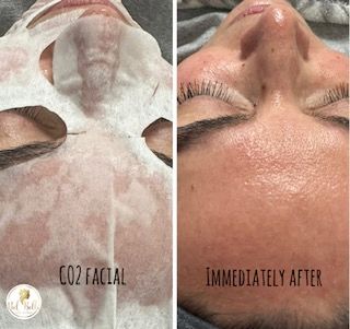 Comparison of skin before and immediately after a CO2 facial treatment.