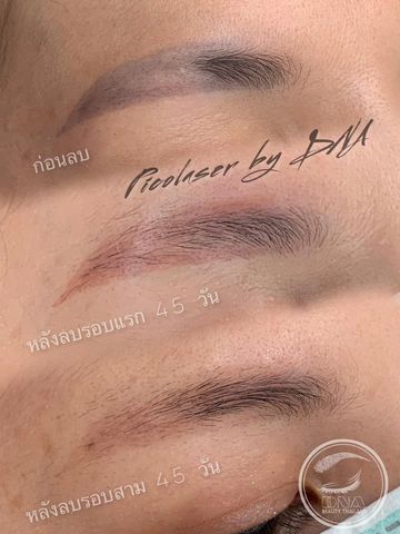 สถาบันสักคิ้วและสอนสักคิ้ว-ปาก-ขอบตา เรียนสักคิ้วง่าย ๆ ทำคิ้วสวยได้จริง DNA Beauty Thailand - ลบคิ้ว, เลเซอร์คิ้ว สถาบันสักคิ้วและสอนสักคิ้ว-ปาก-ขอบตา เรียนสักคิ้วง่าย ๆ ทำคิ้วสวยได้จริง Dna Beauty Thailand - ลบคิ้ว, เลเซอร์คิ้ว