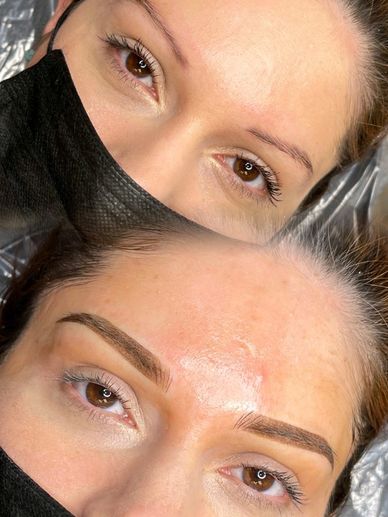 Brow correction