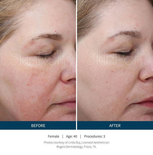 microneedling ogden