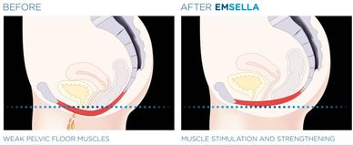 Stress incontinence: is when there is exerted
pressure on the bladder causing leakage.
This can be c